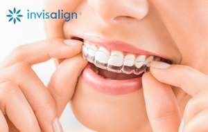 Invisalign Single Set Replacement Tray